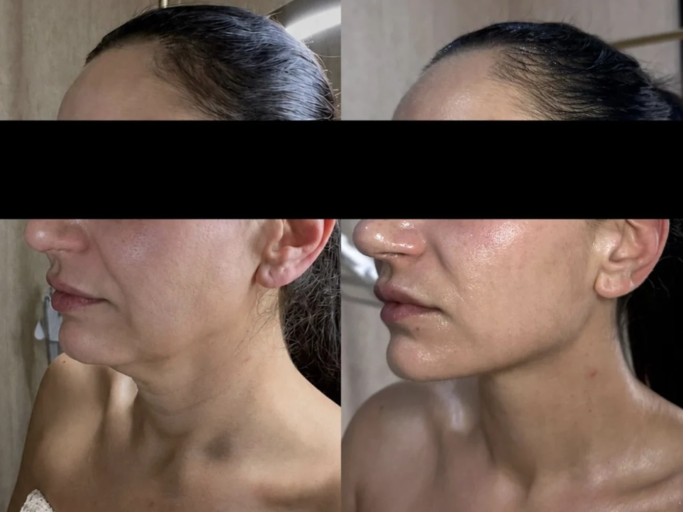 Before and after result 6 from a Saint Serene treatment course